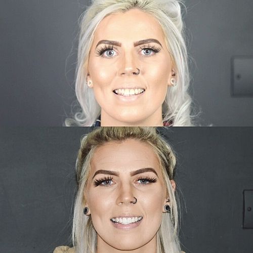 Request A Complimentary Consultation | Cherrybank Dental Spa Edinburgh Before and after treatment at Cherrybank Dental Spa in Edinburgh