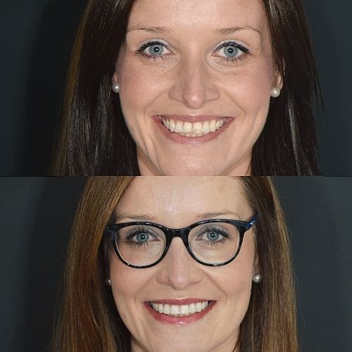 Request A Complimentary Consultation | Cherrybank Dental Spa Edinburgh Before and after treatment at Cherrybank Dental Spa in Edinburgh
