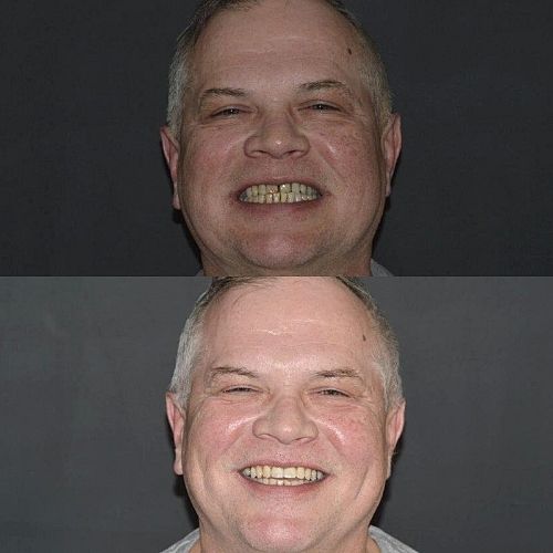 Request A Complimentary Consultation | Cherrybank Dental Spa Edinburgh Before and after treatment at Cherrybank Dental Spa in Edinburgh