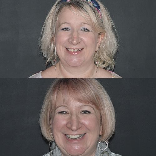 Request A Complimentary Consultation | Cherrybank Dental Spa Edinburgh Before and after treatment at Cherrybank Dental Spa in Edinburgh