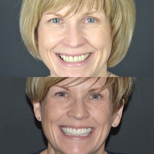 Request A Complimentary Consultation | Cherrybank Dental Spa Edinburgh Before and after treatment at Cherrybank Dental Spa in Edinburgh